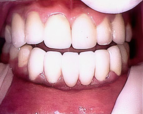 Bridgework After Gigapixel Ai