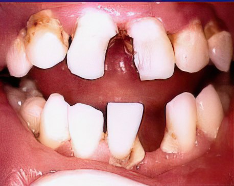 Bridgework Before Gigapixel