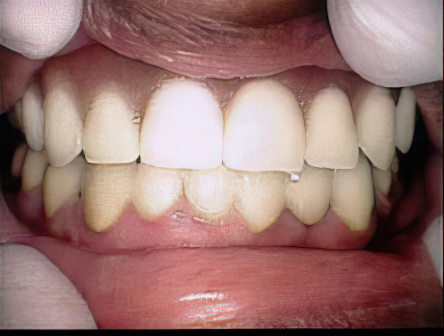 Dentures After Gigapixel