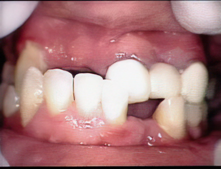 Dentures Before Gigapixel