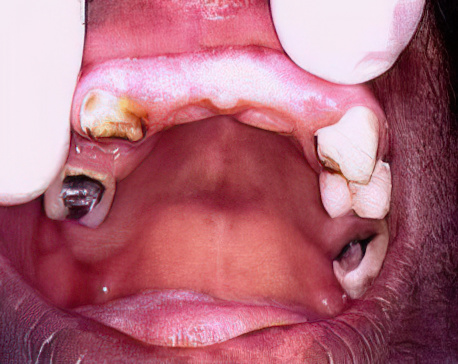 Reconstructive Before Gigapixel